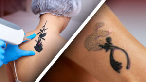 Cos'è la rimozione laser dei tatuaggi?
