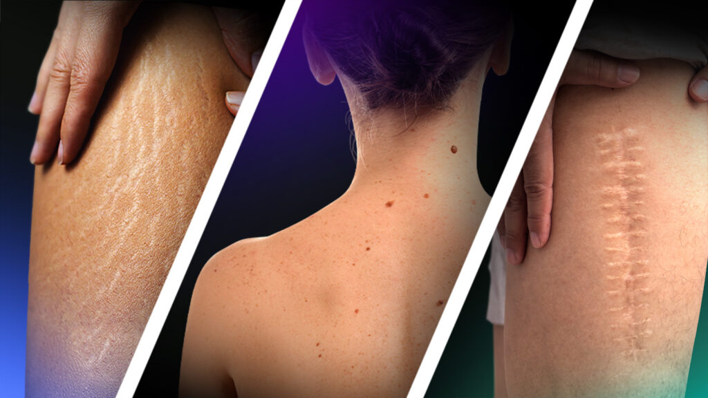 Tatuare sopra nei, cicatrici e smagliature